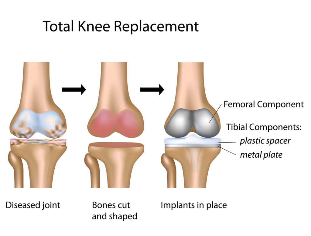 Knee Replacement Surgery Process