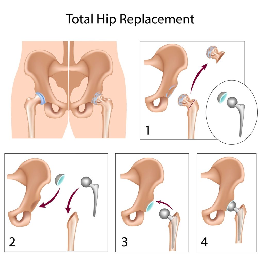 total hip replacement procedure