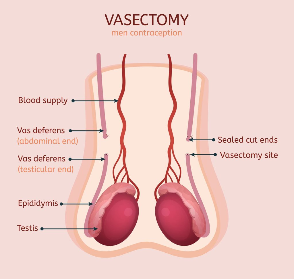 Vasectomy