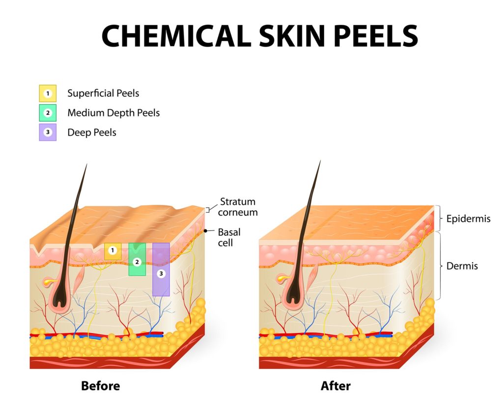 chemical skin peels