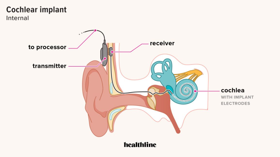 cochlear implant