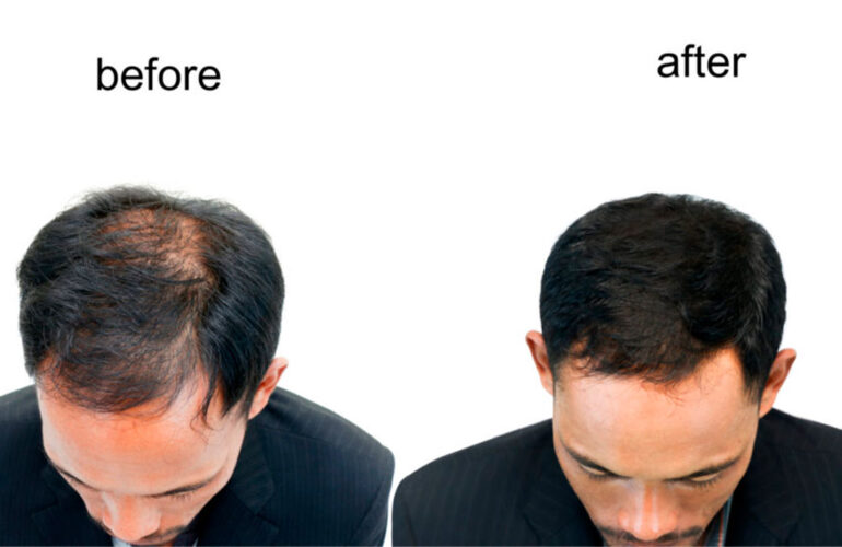 Hair Transplant results