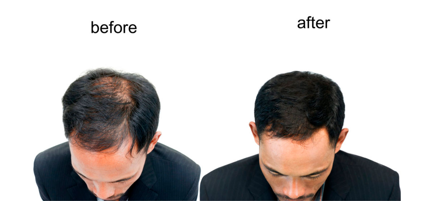 Hair Transplant results