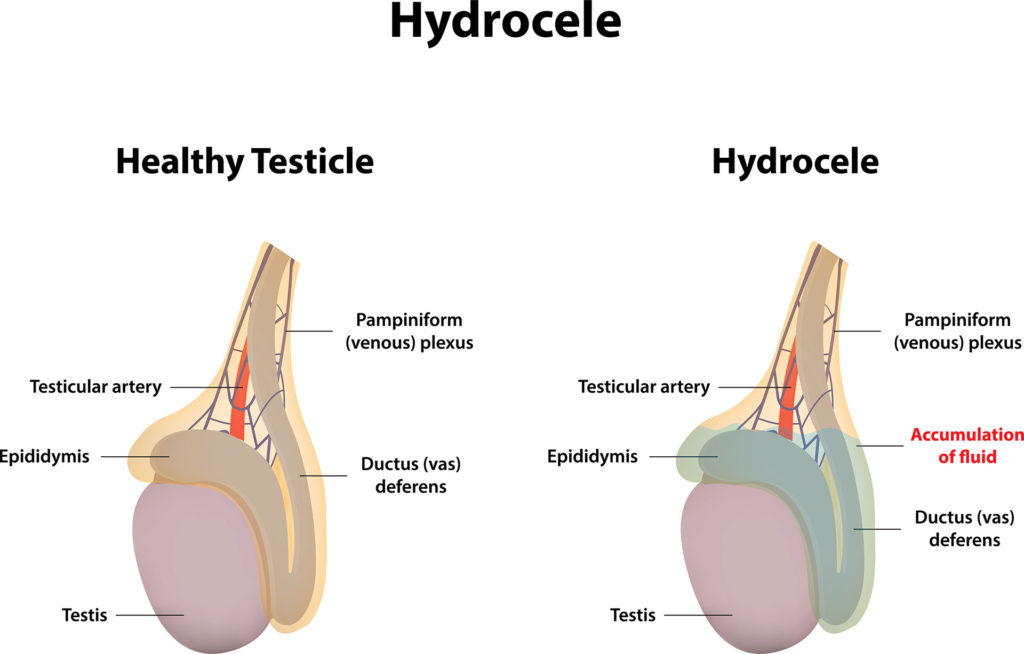 hydrocele