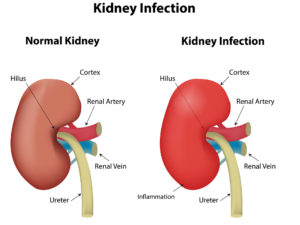 Kidney infection