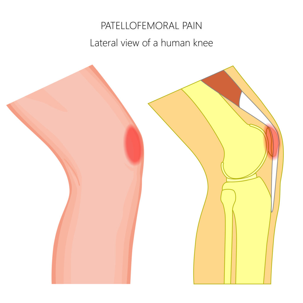 lateral view of a human knee showing patellofemoral pain