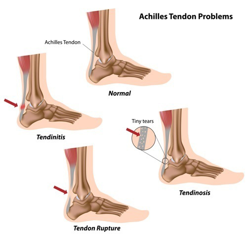 Achilles Tendonitis