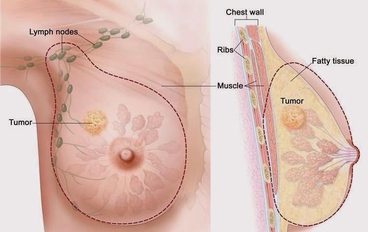 Lumpectomy