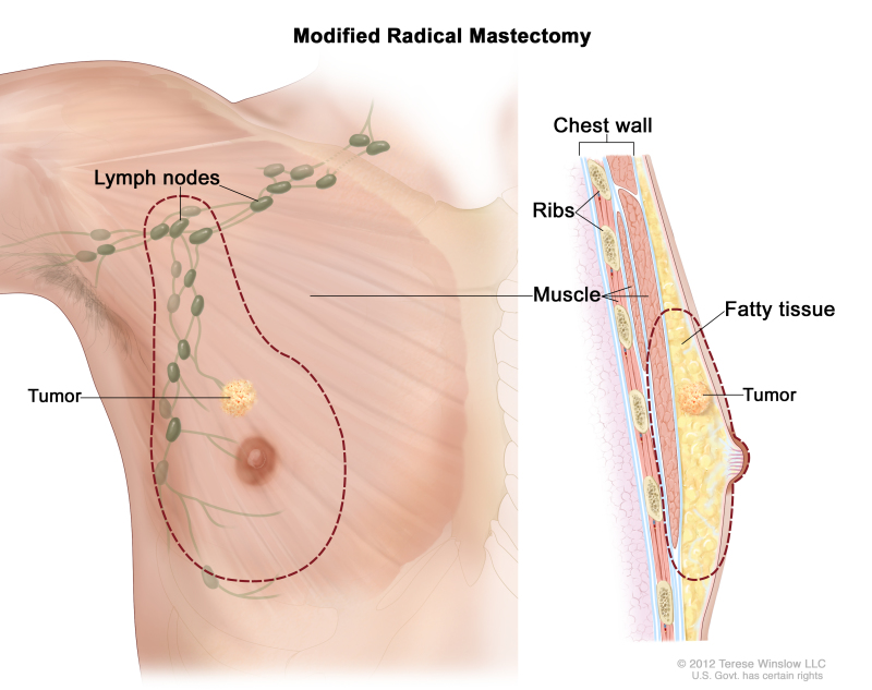 Male Modified Radical Mastectomy