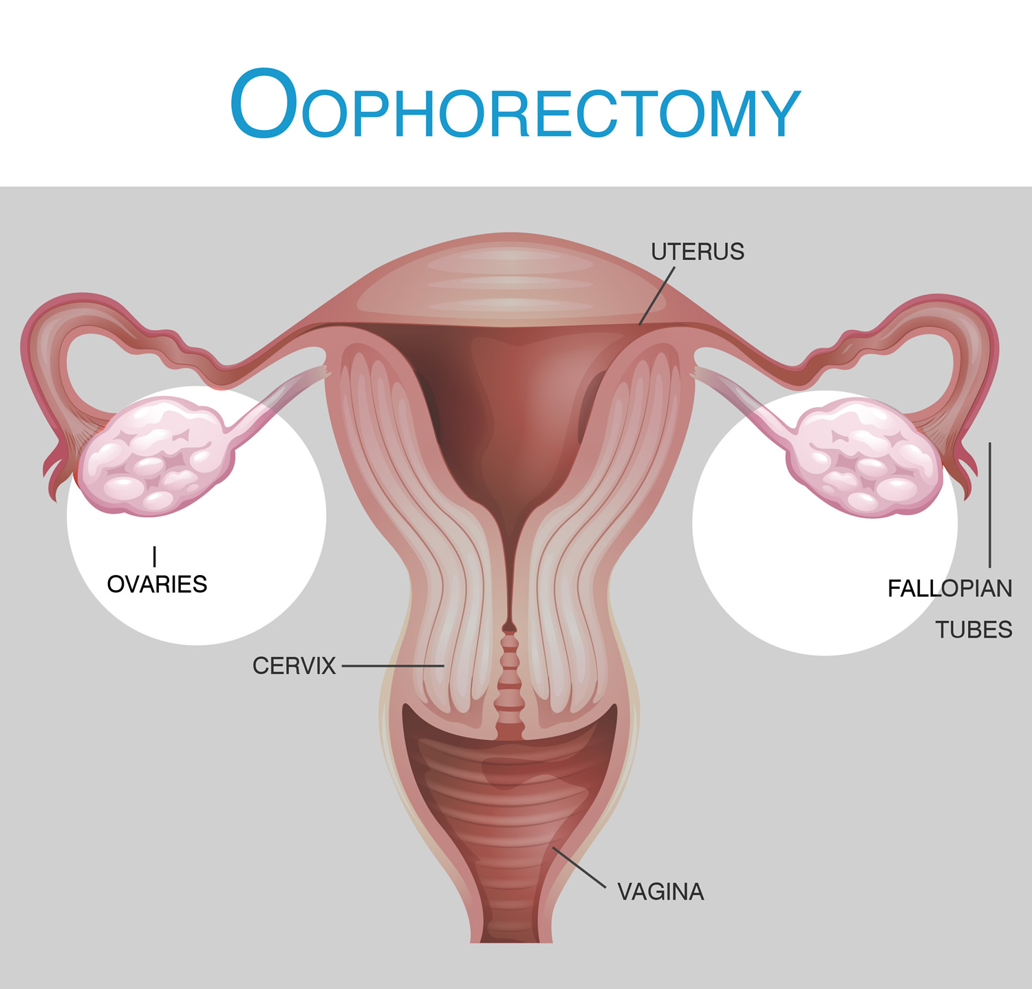 oophorectomy